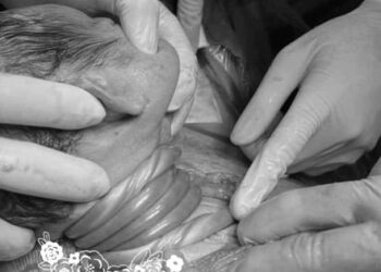 Nghẹt thở giây phút em bé bị dây rốn cuốn cổ 5 vòng ra khỏi bụng mẹ, mẹ bỉm run run: “Nghịch quá con ạ”