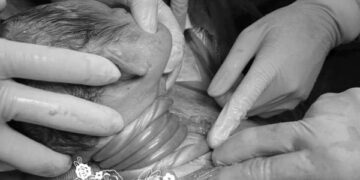 Nghẹt thở giây phút em bé bị dây rốn cuốn cổ 5 vòng ra khỏi bụng mẹ, mẹ bỉm run run: “Nghịch quá con ạ”