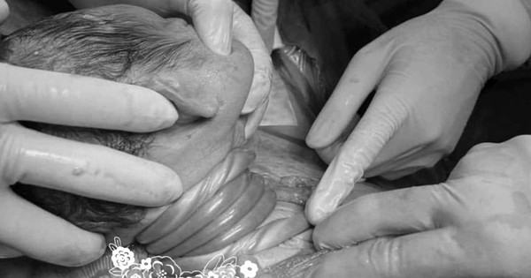 Nghẹt thở giây phút em bé bị dây rốn cuốn cổ 5 vòng ra khỏi bụng mẹ, mẹ bỉm run run: “Nghịch quá con ạ”