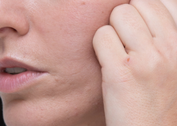 Da nhăn nheo, chảy xệ dù còn trẻ: nguyên nhân do đâu?