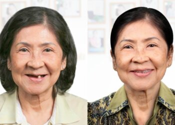4 điểm nhấn khi cấy ghép Implant tại Dr. Care
