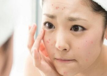 Hướng dẫn cách chăm sóc da mụn vào mùa hè