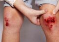 Làm thế nào để xác định xem con bạn có nguy cơ mắc bệnh máu khó đông hay không?