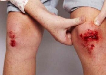 Làm thế nào để xác định xem con bạn có nguy cơ mắc bệnh máu khó đông hay không?