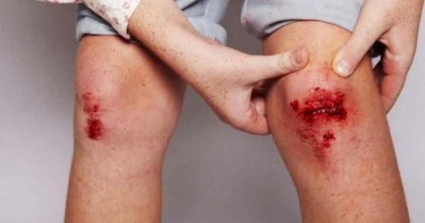 Làm thế nào để xác định xem con bạn có nguy cơ mắc bệnh máu khó đông hay không?