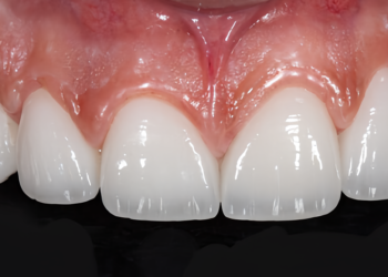 Xu hướng răng sứ, công nghệ tại Nha khoa Hoa Hồng Phương Đông