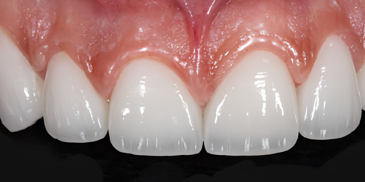 Xu hướng răng sứ, công nghệ tại Nha khoa Hoa Hồng Phương Đông