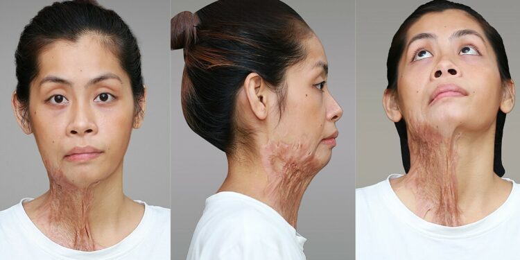 Bệnh viện thẩm mỹ Kangnam tái tạo vết sẹo bỏng axit dài hơn 30 cm