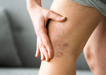 Biến chứng có thể gặp khi điều trị giãn tĩnh mạch chân bằng laser xung dài