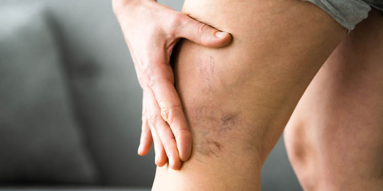 Biến chứng có thể gặp khi điều trị giãn tĩnh mạch chân bằng laser xung dài