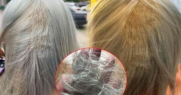 Kiếp nạn khi tẩy tóc: Làm hết 8.5 triệu, vẫn phải mua thêm bộ tóc giả về đội vì tóc rụng gần hết