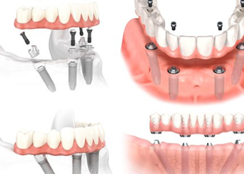 Ưu, nhược điểm của phương pháp Implant All On 4