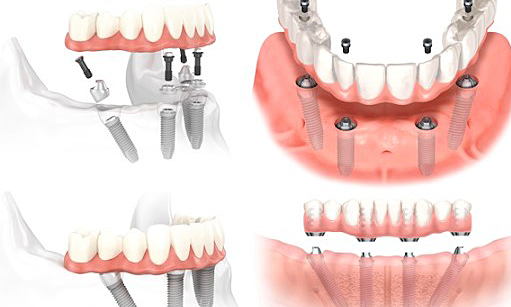 Ưu, nhược điểm của phương pháp Implant All On 4