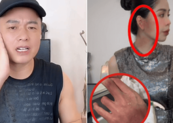 Hằng Du Mục chia sẻ về vết bầm trên cơ thể ẩn ý đây không phải lần đầu, chồng xác nhận xảy ra xô xát