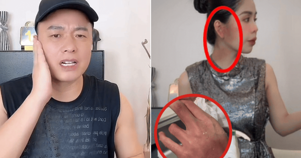 Hằng Du Mục chia sẻ về vết bầm trên cơ thể ẩn ý đây không phải lần đầu, chồng xác nhận xảy ra xô xát