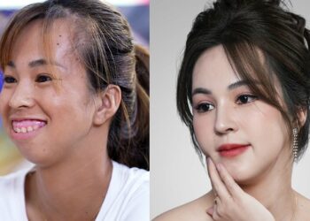 Cô giáo hàm hô, cười hở lợi ‘lột xác’ sau ba lần phẫu thuật