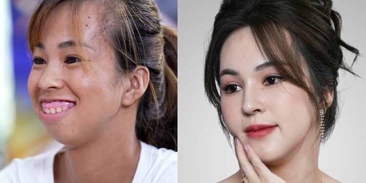 Cô giáo hàm hô, cười hở lợi ‘lột xác’ sau ba lần phẫu thuật
