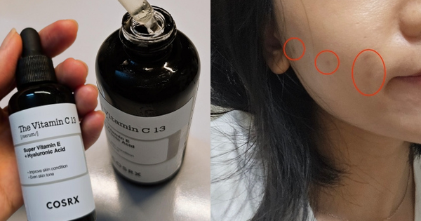 Da nhạy cảm và nhiều thâm mụn, mình đã tìm được loại serum vitamin C thấm nhanh và hiệu quả làm sáng khá ổn