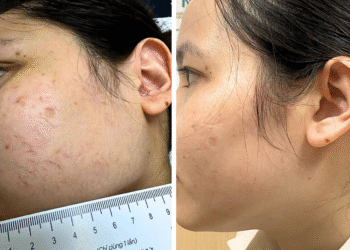 Ưu nhược điểm của các phương pháp điều trị giãn tĩnh mạch