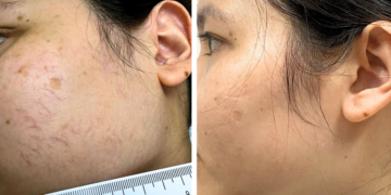 Ưu nhược điểm của các phương pháp điều trị giãn tĩnh mạch