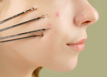 Bí quyết nặn mụn đúng cách