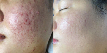 Thoát mụn dai dẳng nhờ giải pháp chuẩn y khoa