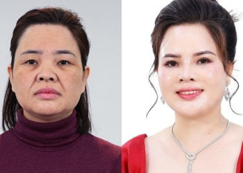 Nhiều phụ nữ ‘lột xác’ sau chương trình làm đẹp của Viện thẩm mỹ KangJin