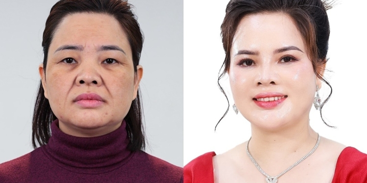 Nhiều phụ nữ ‘lột xác’ sau chương trình làm đẹp của Viện thẩm mỹ KangJin